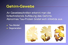 Gehirn-Untersuchungen zeigen bei Alzheimer zunehmende Ablagerungen.